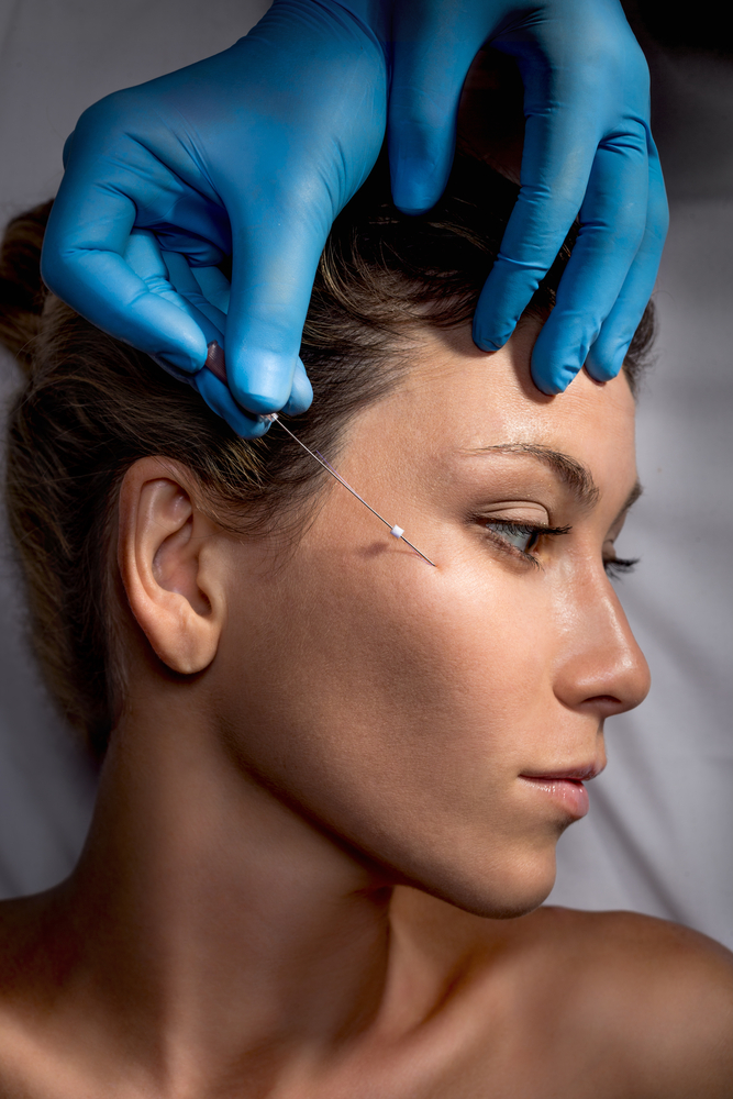 Profile view of a woman during a PDO threadlift