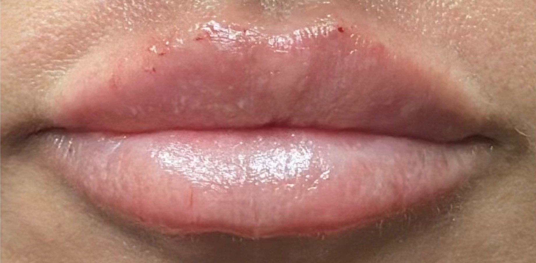 After Image: Lip Filler - front