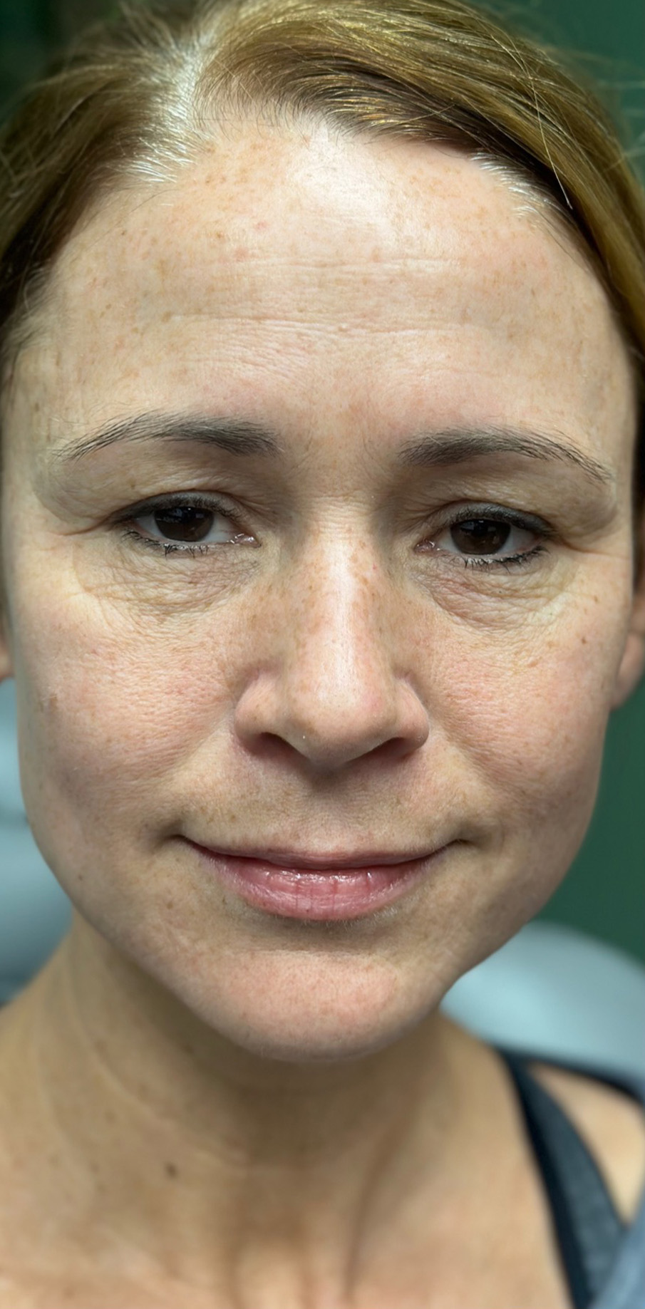 Before Image: Facial and Lip Filler - front