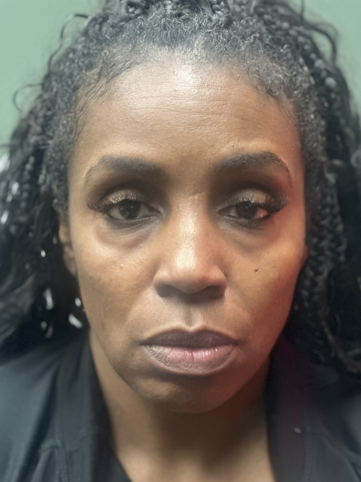 Before Image: EZ Gel PRF - front