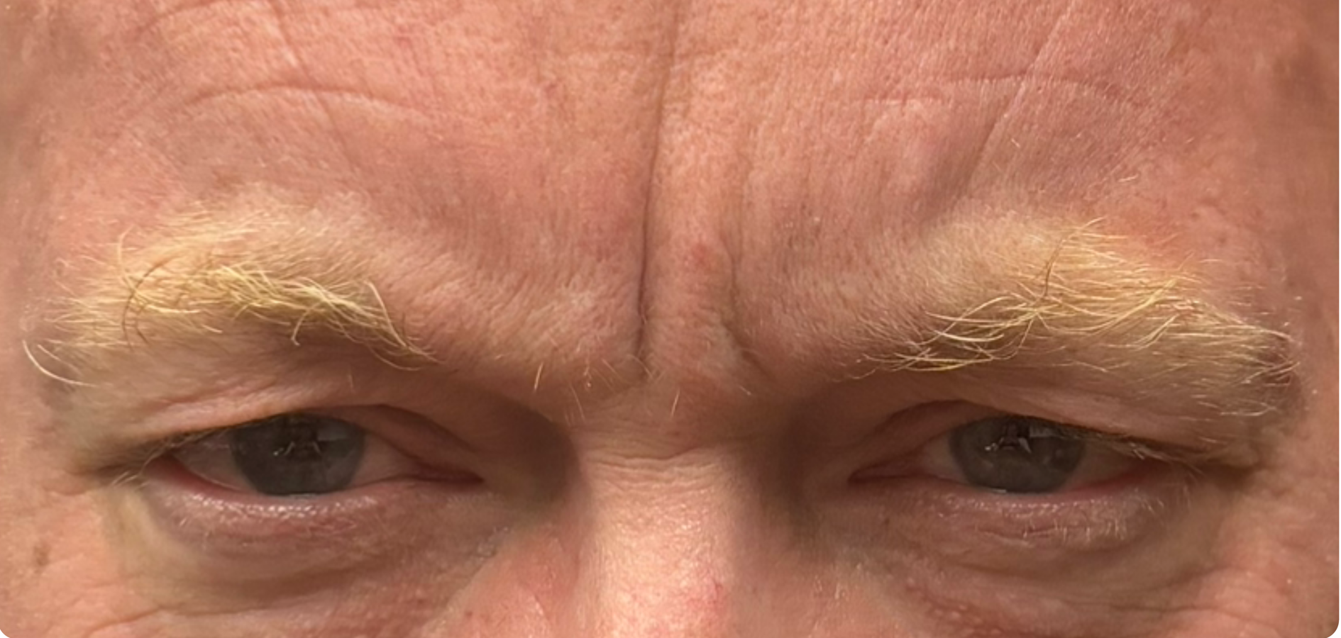 Before Image: Botox - front