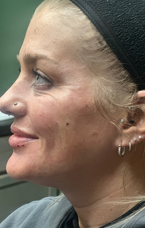 After Image: Facial Rejuvenation - left-side