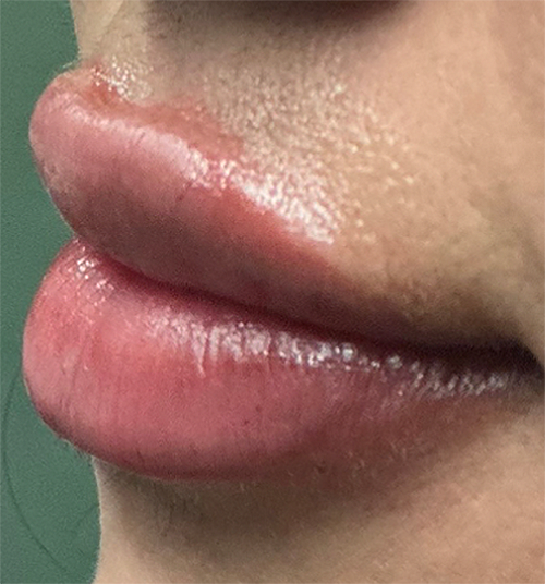 After Image: Lip Filler - left-front-oblique