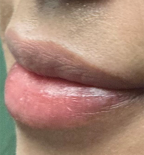 Before Image: Lip Filler - left-front-oblique