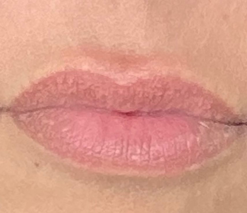 Before Image: Lip Filler - front