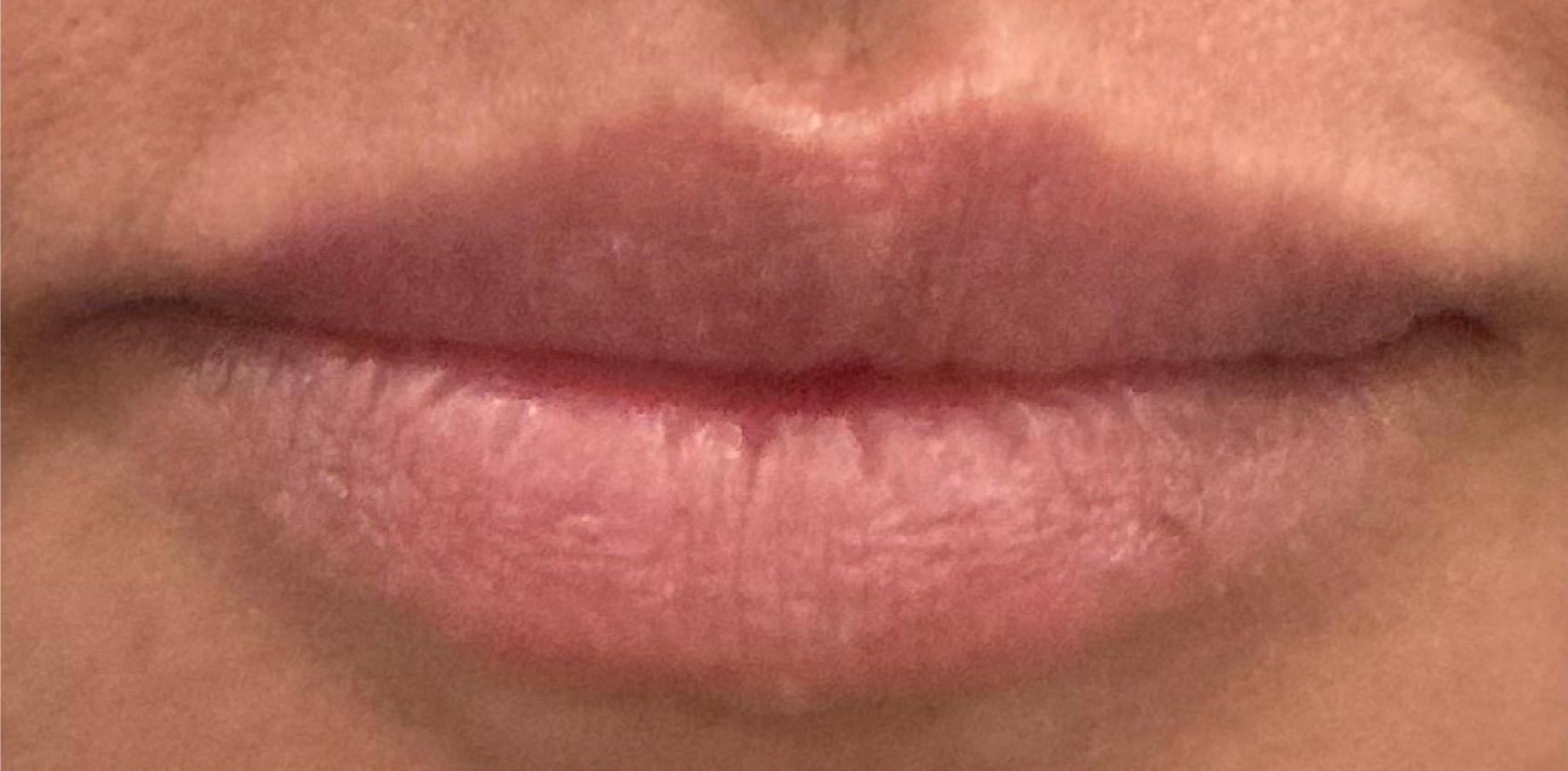 Before Image: Lip Filler - front
