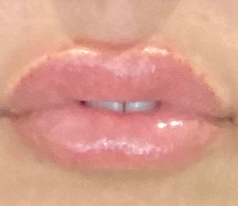 After Image: Lip Filler - front