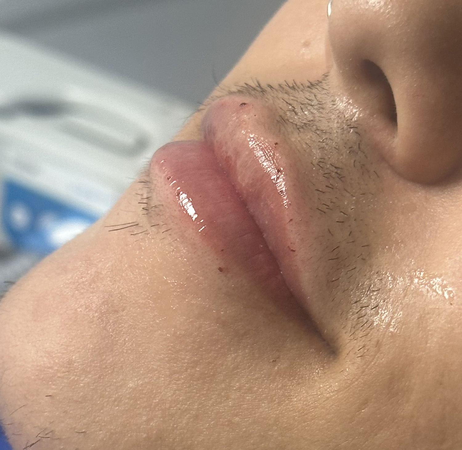 After Image: Lip Filler - left-front-oblique
