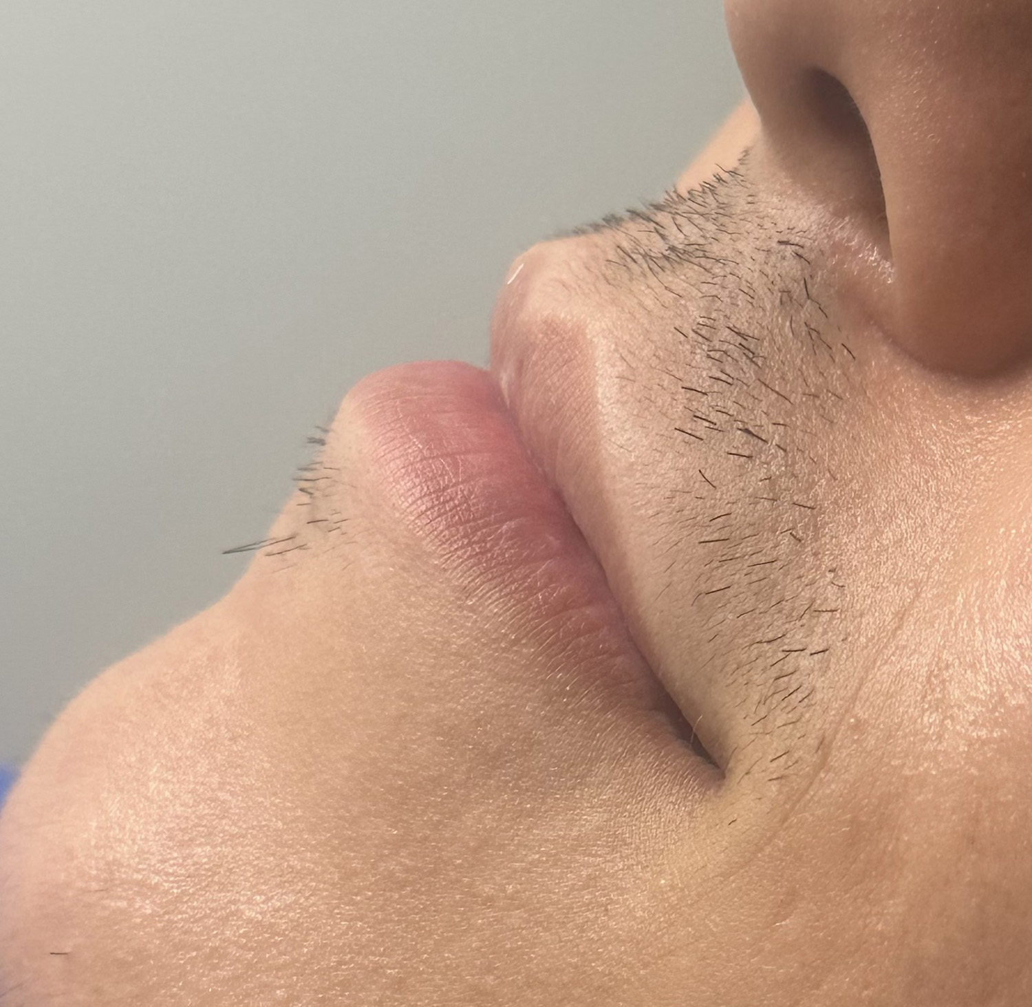 Before Image: Lip Filler - left-front-oblique
