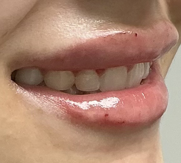After Image: Lip Filler - right-front-oblique