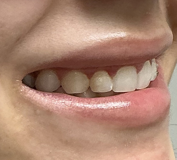 Before Image: Lip Filler - right-front-oblique