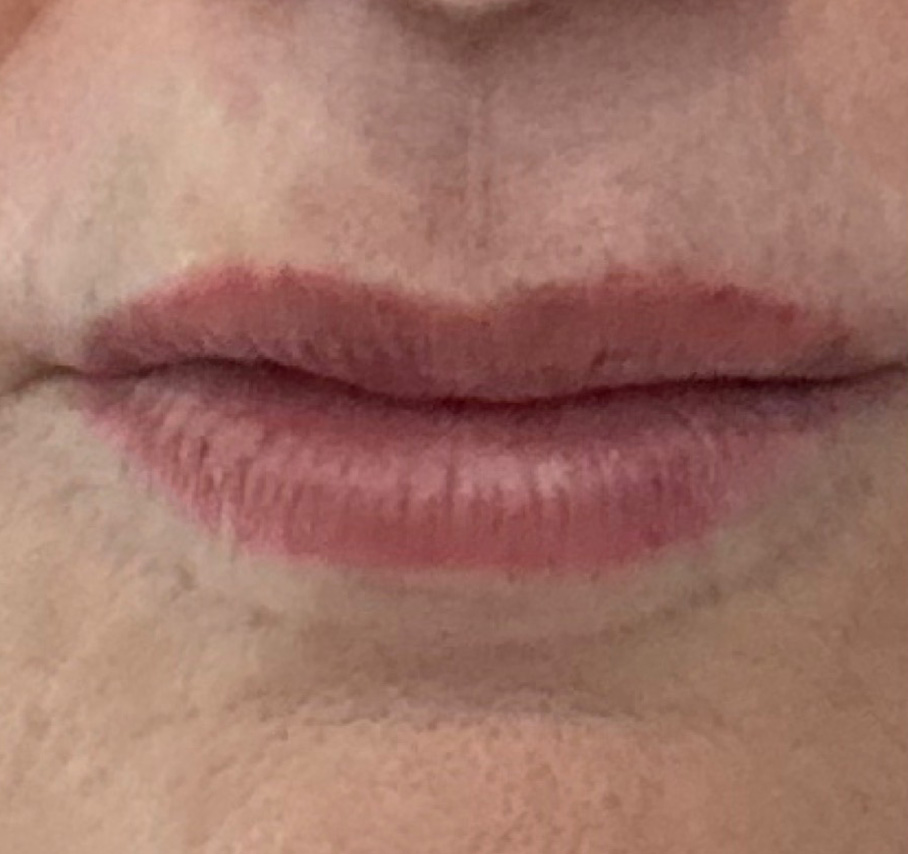 After Image: Lip Filler - front