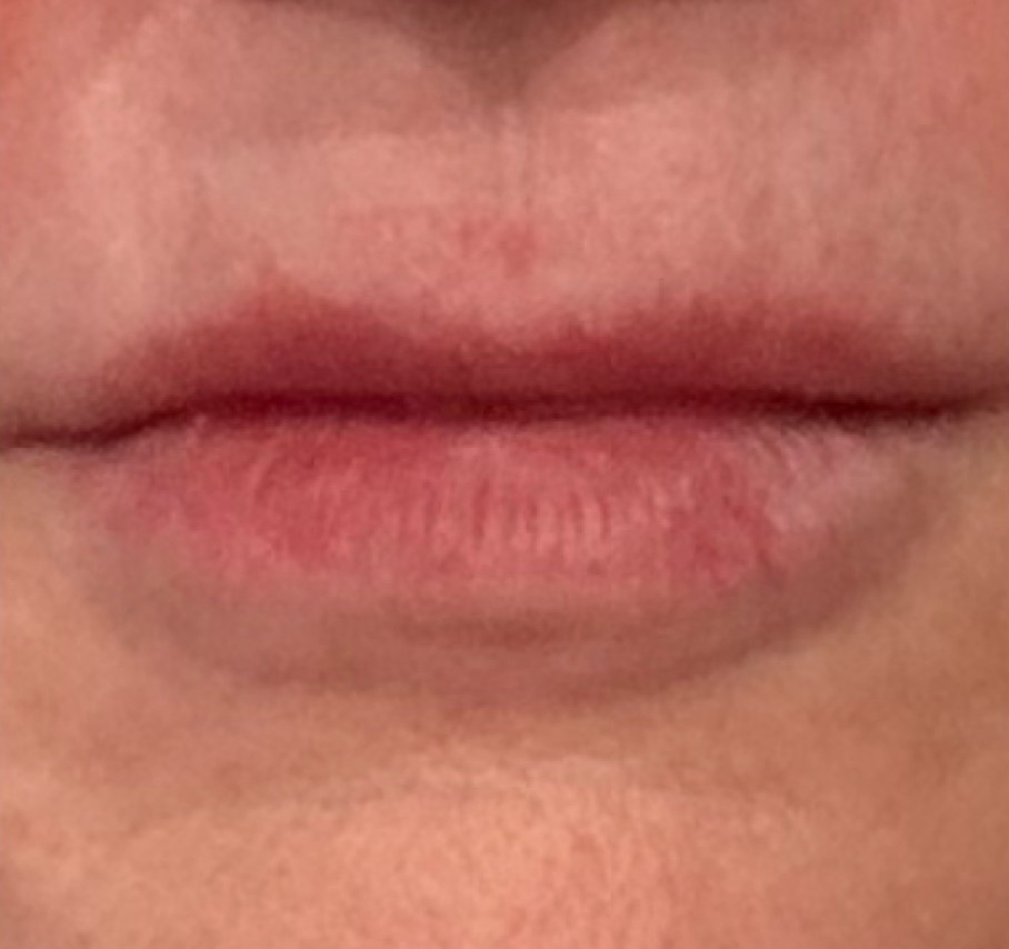 Before Image: Lip Filler - front