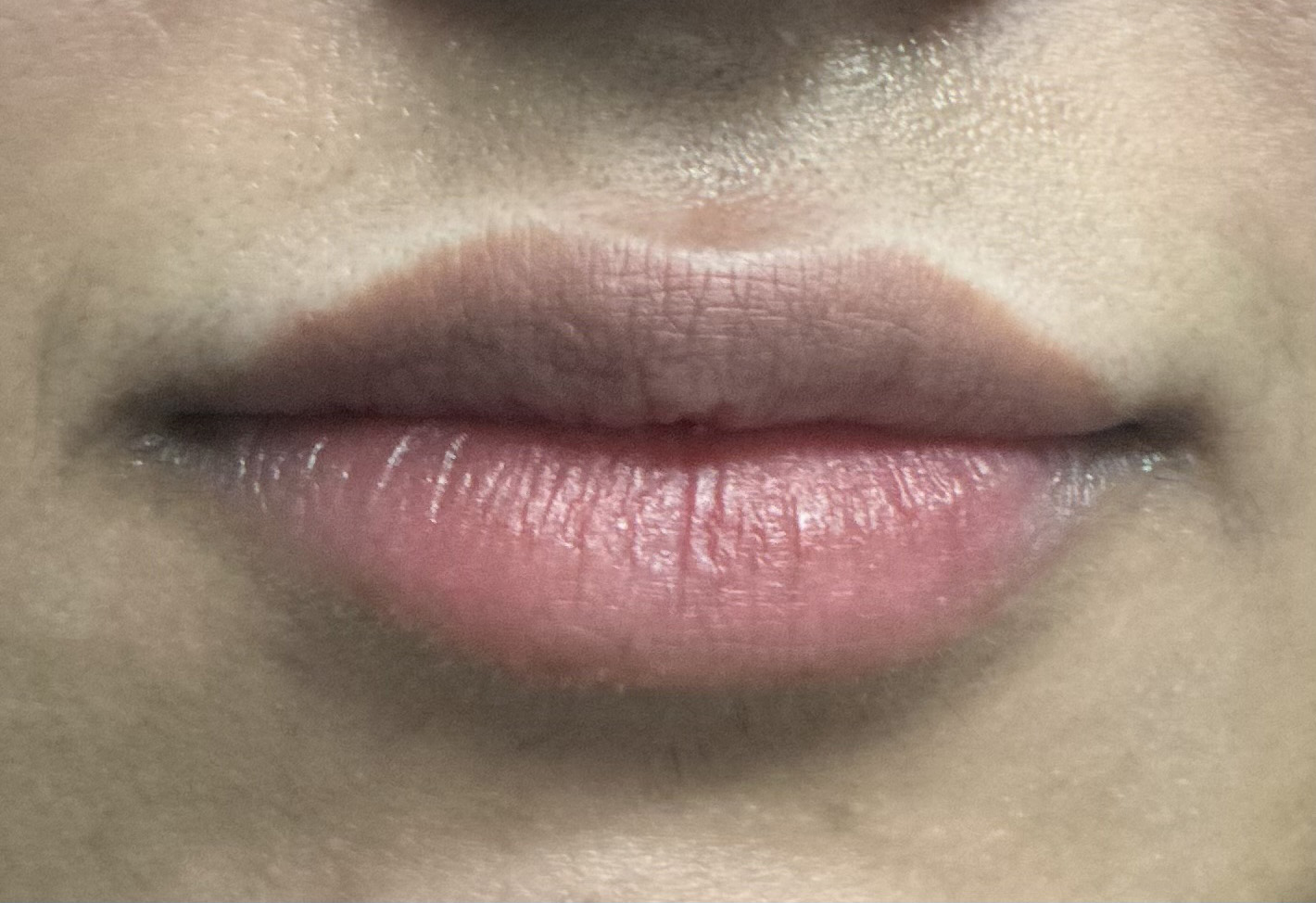 Before Image: Lip Filler - front