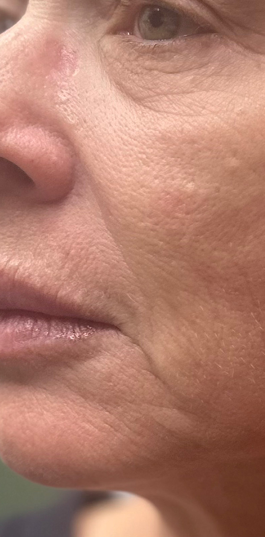 After Image: Morpheus8 - left-front-oblique