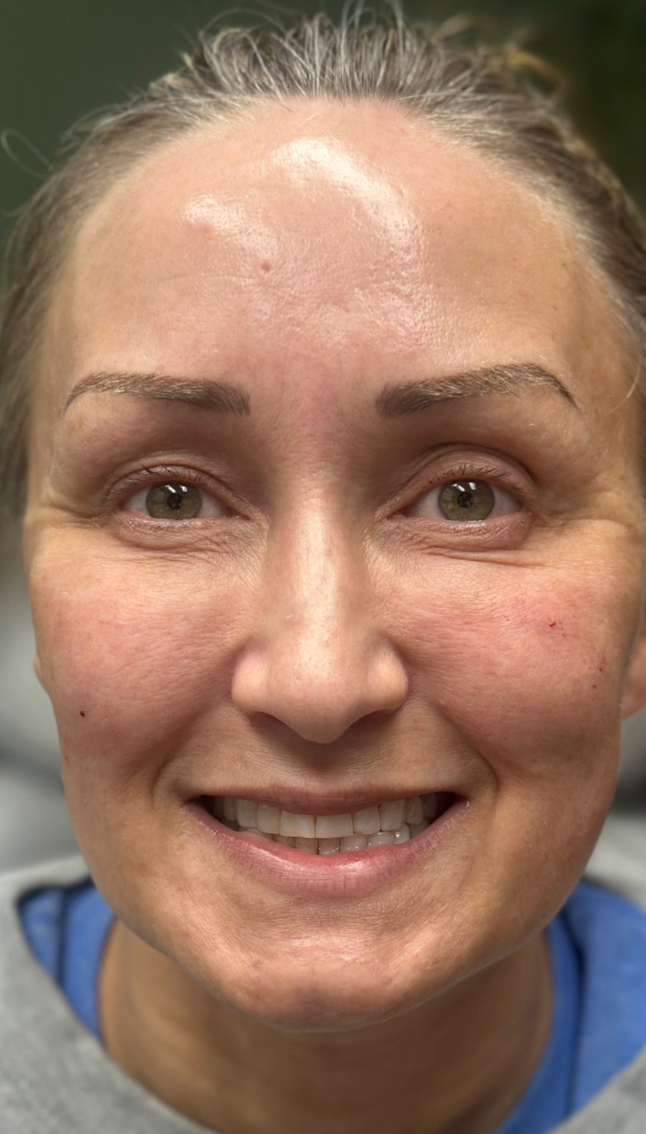 After Image: EZ Gel PRF - front