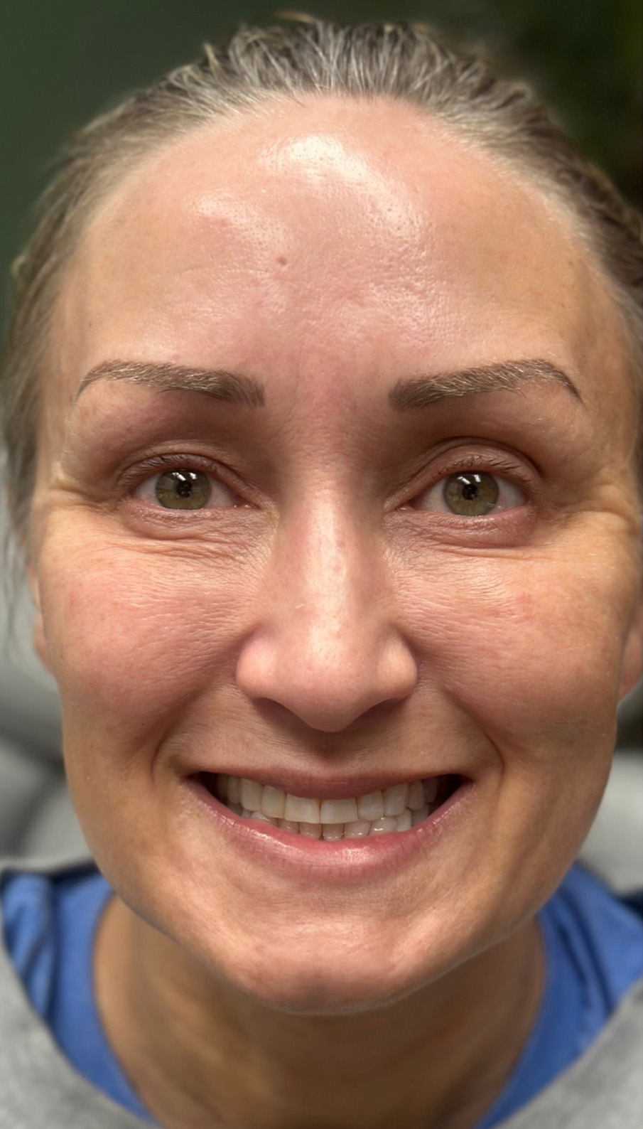 Before Image: EZ Gel PRF - front