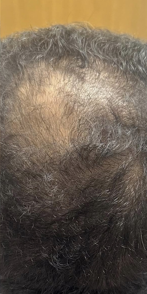 After Image: PRF Hair restoration - back