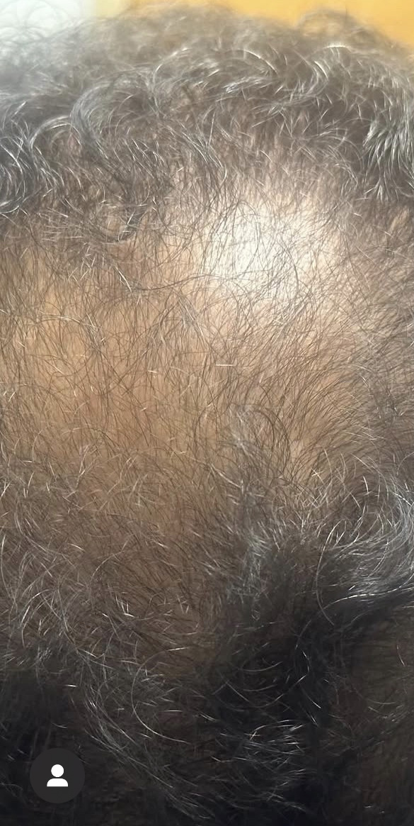 Before Image: PRF Hair restoration - back