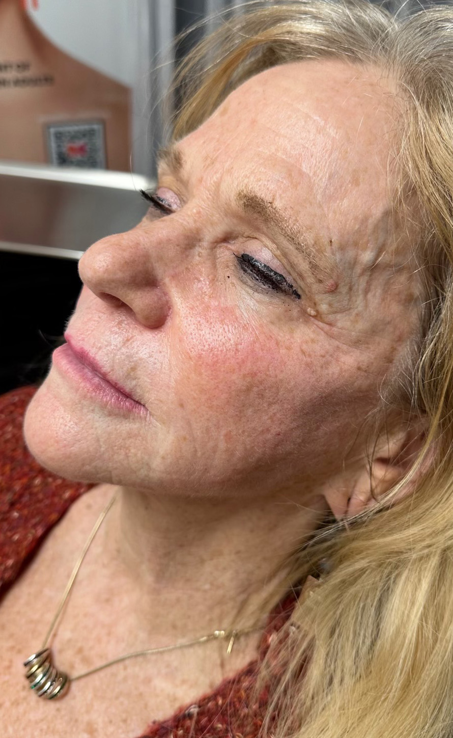 After Image: Sculptra - left-front-oblique