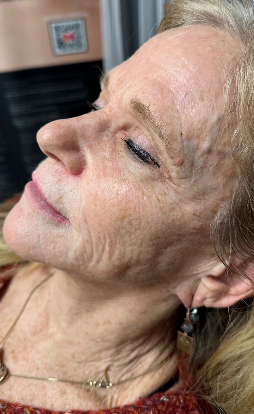 Before Image: Sculptra - left-front-oblique