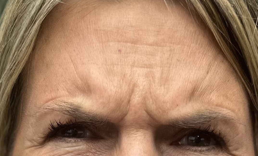 Before Image: Botox - front