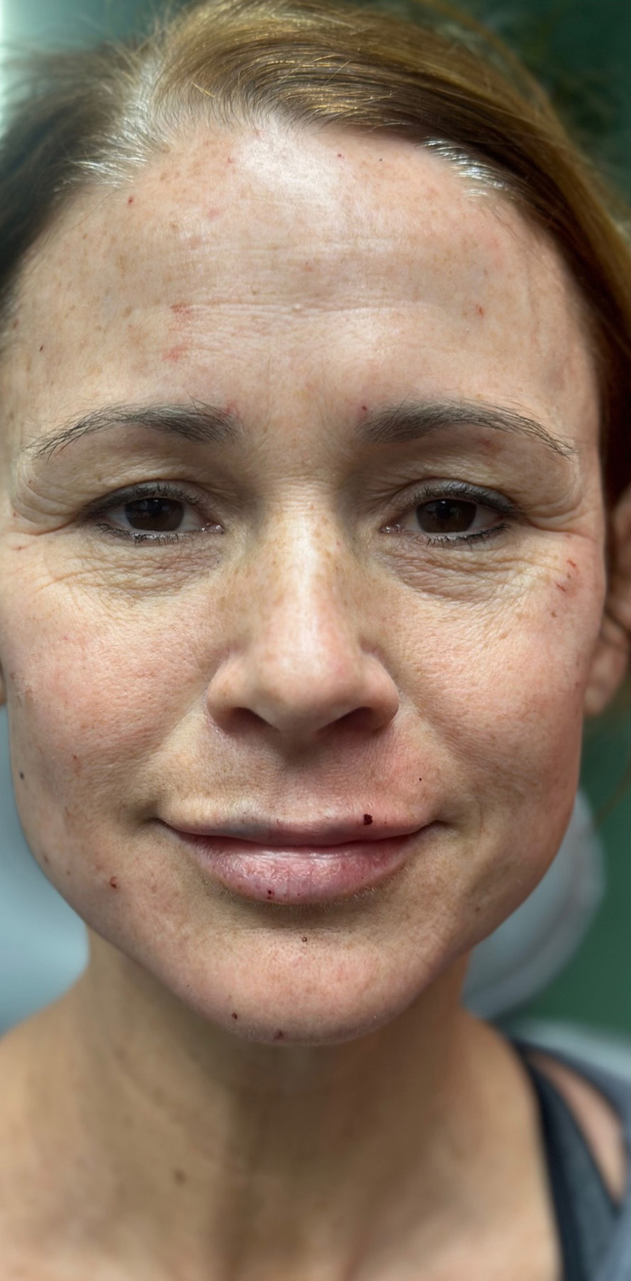 After Image: Facial and Lip Filler - front